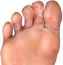 foot-with-moccasin-type-infection.jpg